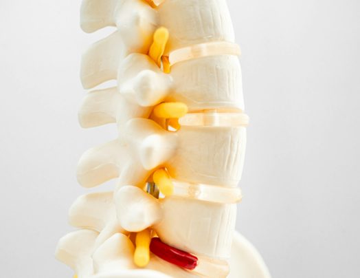 Lumbar spine displaced herniated disc fragment, spinal nerve and bone. Model for treatment medical